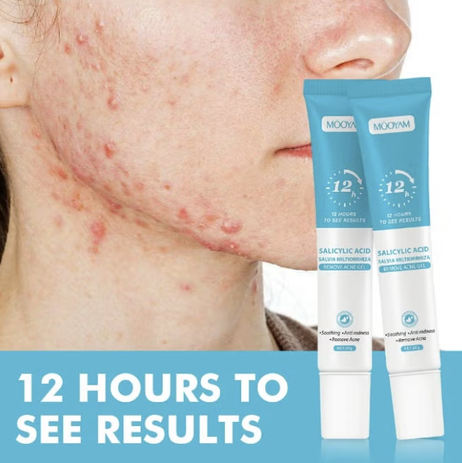 AcneZero Pro - Serum de Acido Salicilico - 12 Horas Resultados – Image 3